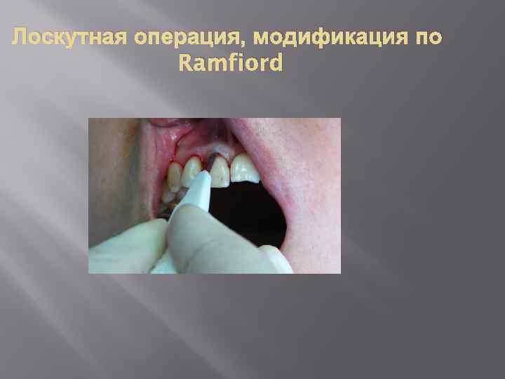 Лоскутная операция, модификация по Ramfiord 