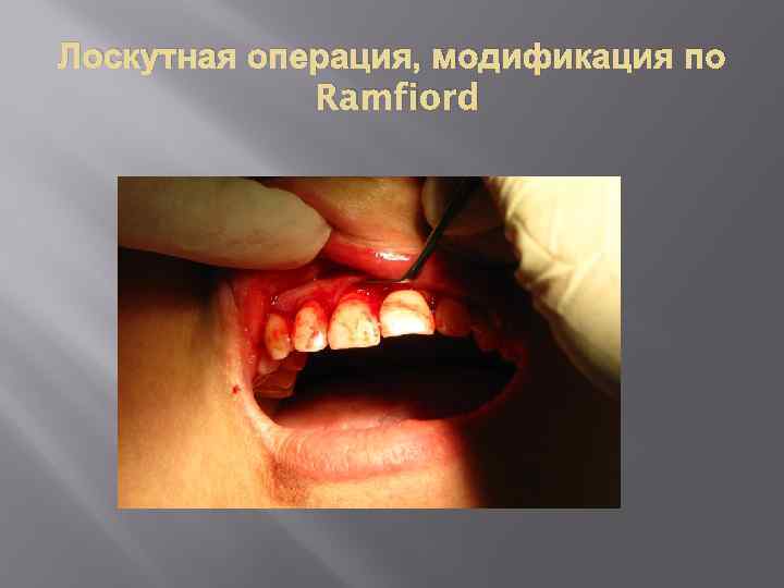 Лоскутная операция, модификация по Ramfiord 