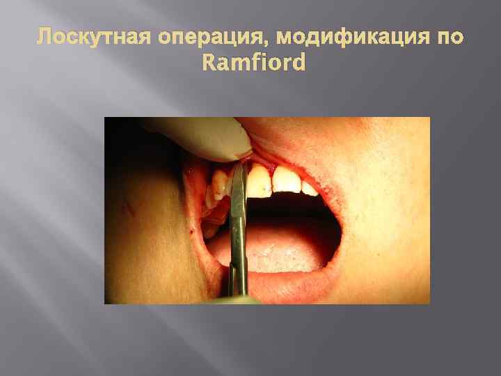 Лоскутная операция, модификация по Ramfiord 