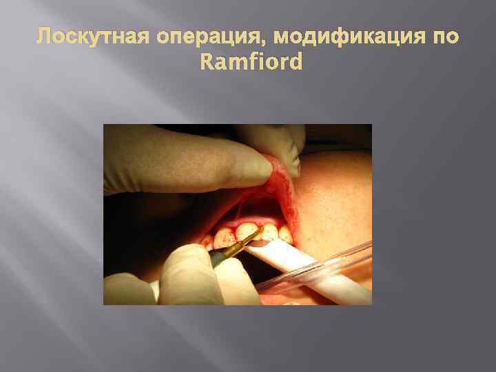 Лоскутная операция, модификация по Ramfiord 