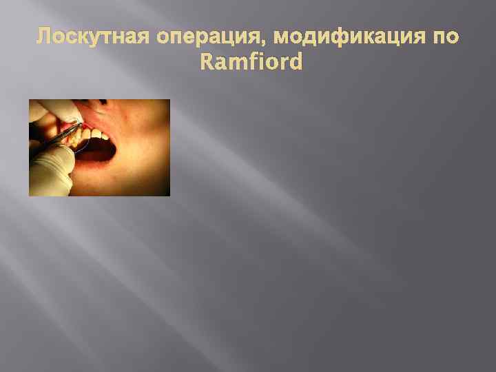 Лоскутная операция, модификация по Ramfiord 