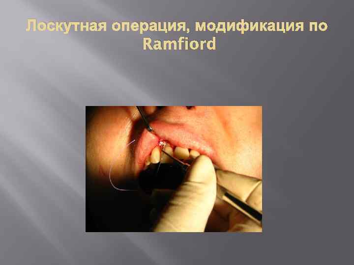 Лоскутная операция, модификация по Ramfiord 