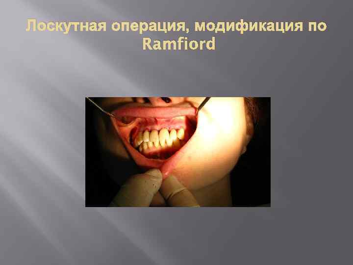 Лоскутная операция, модификация по Ramfiord 