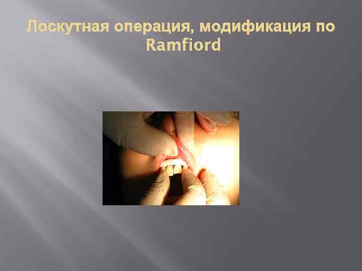 Лоскутная операция, модификация по Ramfiord 