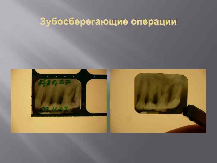 Зубосберегающие операции 
