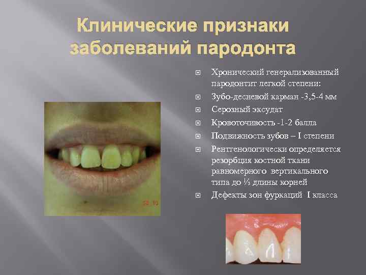 Клинические признаки заболеваний пародонта Хронический генерализованный пародонтит легкой степени: Зубо-десневой карман -3, 5 -4
