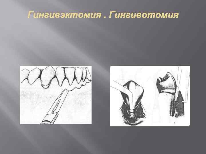 Гингивэктомия. Гингивотомия 