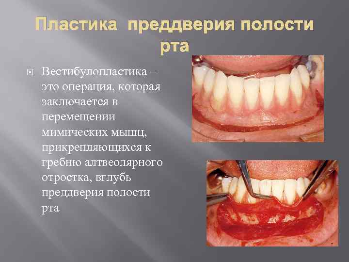 Пластика преддверия полости рта Вестибулопластика – это операция, которая заключается в перемещении мимических мышц,