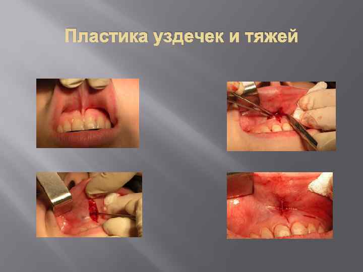 Пластика уздечек и тяжей 