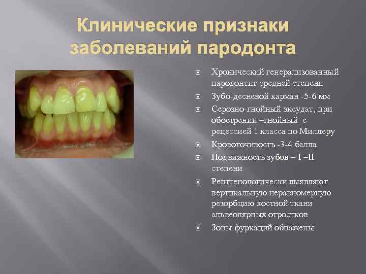 Пародонтит очаговый презентация