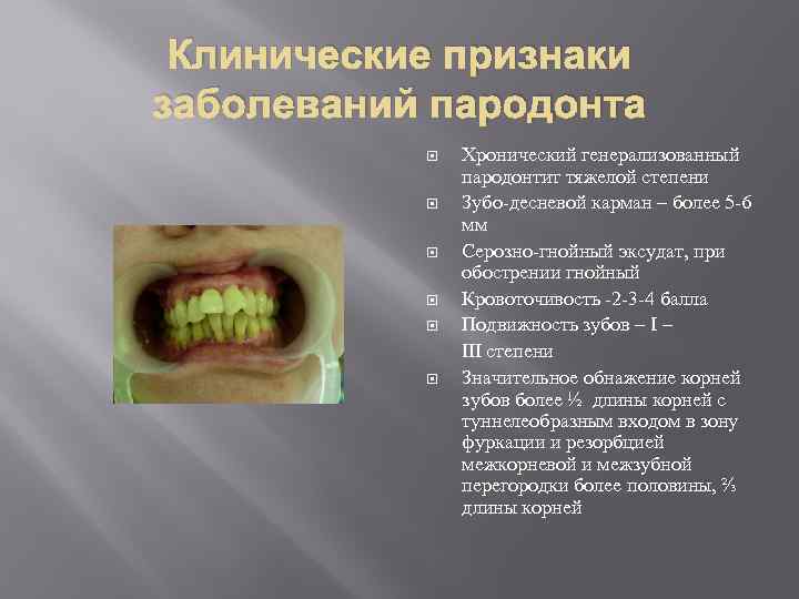 Клинические признаки заболеваний пародонта Хронический генерализованный пародонтит тяжелой степени Зубо-десневой карман – более 5