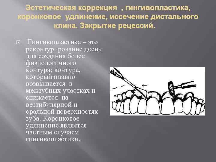 Эстетическая коррекция , гингивопластика, коронковое удлинение, иссечение дистального клина. Закрытие рецессий. Гингивопластика – это