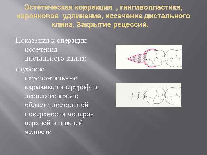 Эстетическая коррекция , гингивопластика, коронковое удлинение, иссечение дистального клина. Закрытие рецессий. Показания к операции