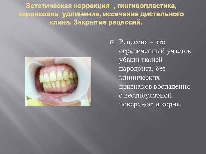 Эстетическая коррекция , гингивопластика, коронковое удлинение, иссечение дистального клина. Закрытие рецессий. Рецессия – это
