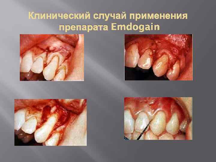 Клинический случай применения препарата Emdogain 