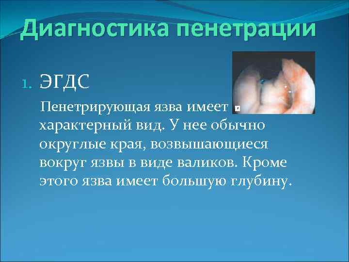 Диагностика пенетрации 1. ЭГДС Пенетрирующая язва имеет характерный вид. У нее обычно округлые края,