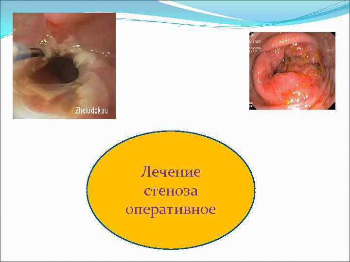 Лечение стеноза оперативное 