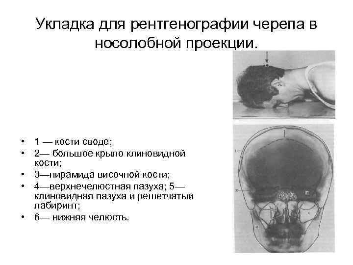 Укладка для рентгенографии черепа в носолобной проекции. • 1 — кости своде; • 2—