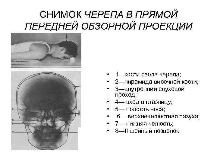 СНИМОК ЧЕРЕПА В ПРЯМОЙ ПЕРЕДНЕЙ ОБЗОРНОЙ ПРОЕКЦИИ • 1—кости свода черепа; • 2—пирамида височной