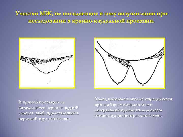 Участки МЖ, не попадающие в зону визуализации при исследовании в кранио-каудальной проекции. В прямой