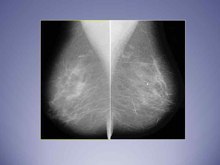 Проекции в маммографии