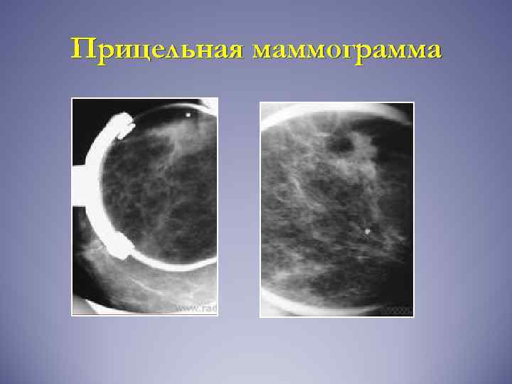 Центр маммограммы. Прицельный снимок маммографии. Прицельная маммография молочной железы. Методика выполнения прицельной маммографии. Маммография укладки.