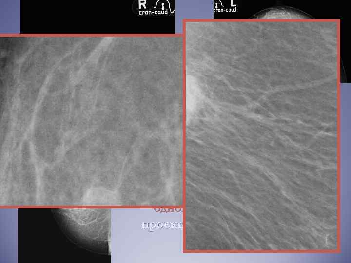 Маммография проекции