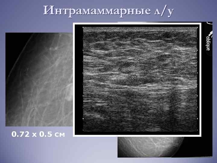 Интрамаммарные л/у 0. 72 х 0. 5 см 