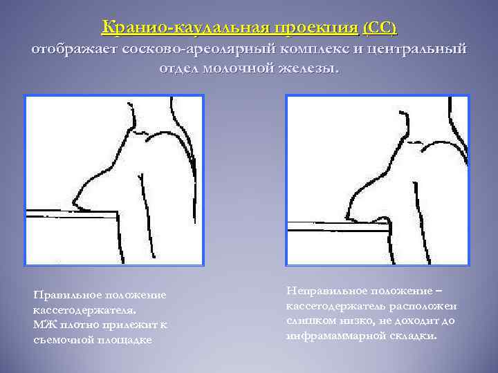 Как правильно маммография ударение