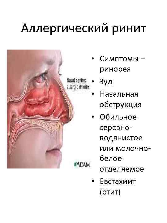 Аллергический ринит • Симптомы – ринорея • Зуд • Назальная обструкция • Обильное серозноводянистое