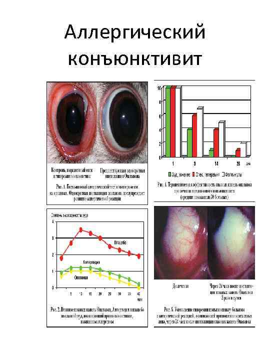 Аллергический конъюнктивит 