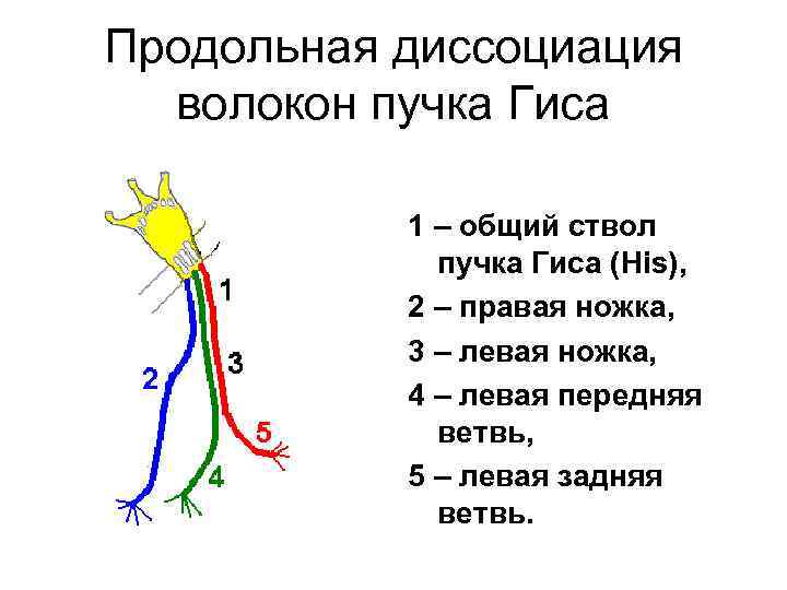 Продольная диссоциация волокон пучка Гиса 1 – общий ствол пучка Гиса (His), 2 –