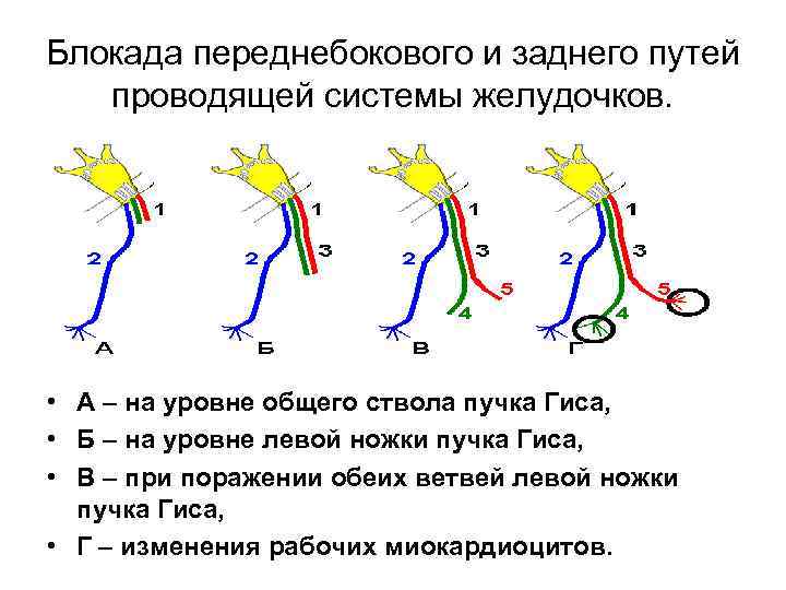 Блокада переднебокового и заднего путей проводящей системы желудочков. • А – на уровне общего