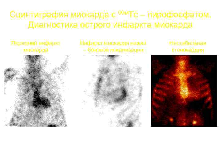 Сцинтиграфия миокарда с 99 м. Тс – пирофосфатом. Диагностика острого инфаркта миокарда Передний инфаркт