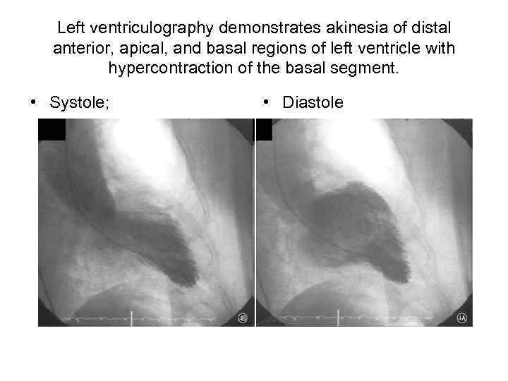 Left ventriculography demonstrates akinesia of distal anterior, apical, and basal regions of left ventricle