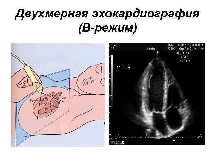 Двухмерная эхокардиография (В-режим) 