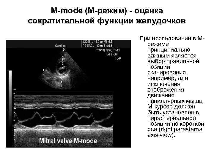M-mode (M-режим) - оценка сократительной функции желудочков При исследовании в Мрежиме принципиально важным является