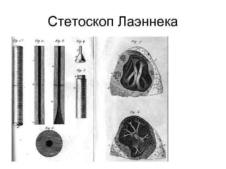 Стетоскоп Лаэннека 