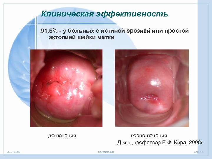 Клиническая эффективность 91, 6% - у больных с истиной эрозией или простой эктопией шейки
