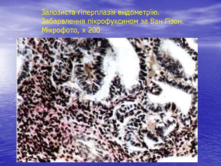 Залозиста гіперплазія ендометрію. Забарвлення пікрофуксином за Ван Гізон. Мікрофото, х 200 