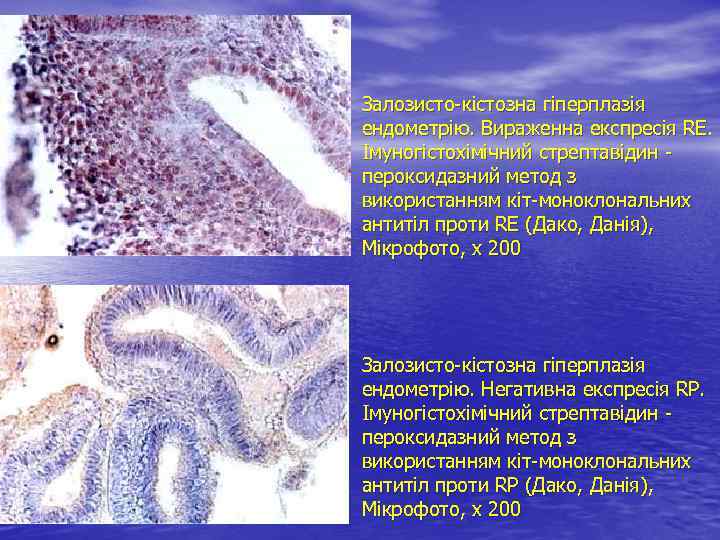 Залозисто-кістозна гіперплазія ендометрію. Вираженна експресія RE. Імуногістохімічний стрептавідин - пероксидазний метод з використанням кіт-моноклональних
