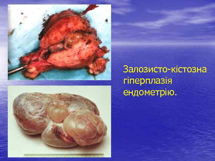 Залозисто-кістозна гіперплазія ендометрію. 