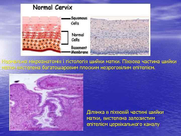 Нормальна мікроанатомія і гістологія шийки матки. Піхвова частина шийки матки вистелена багатошаровим плоским незроговілим