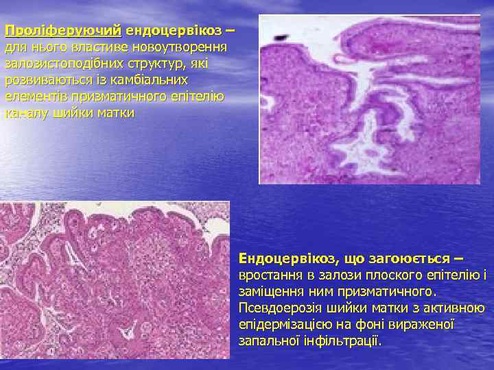 Проліферуючий ендоцервікоз – для нього властиве новоутворення залозистоподібних структур, які розвиваються із камбіальних елементів