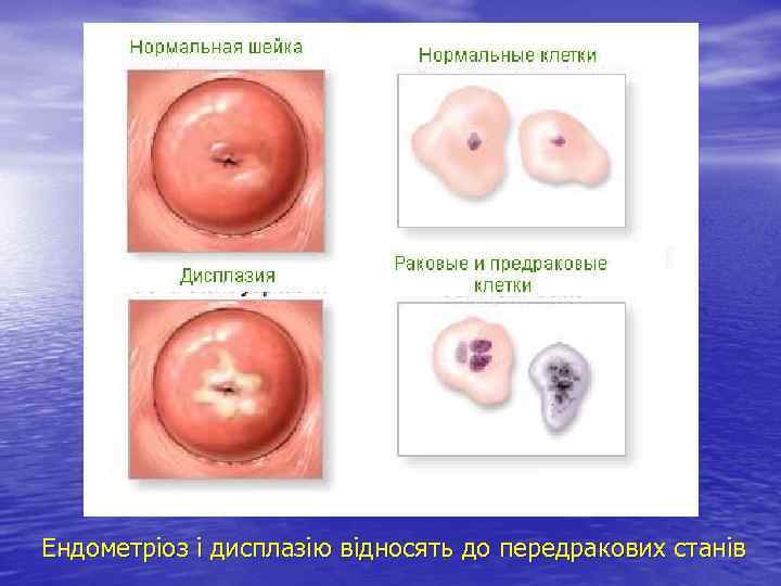 Ендометріоз і дисплазію відносять до передракових станів 