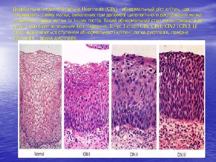 Цервікальна інтраепітеліальна Неоплазія (CIN) - абнормальный ріст клітин, що покривають шийку матки, виявлених при
