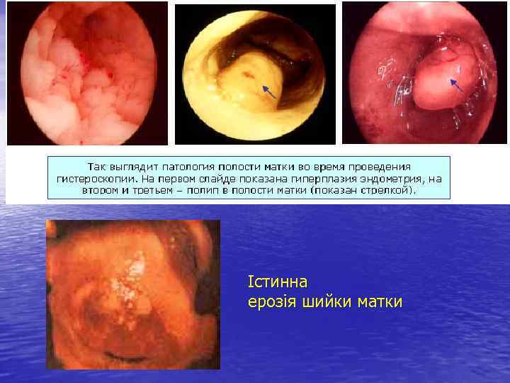 Істинна ерозія шийки матки 