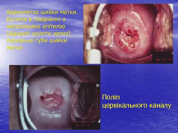 Аденоматоз шийки матки. Ектопія в поєднанні з метаплазією епітелію (відкриті крипти залоз) передньої губи