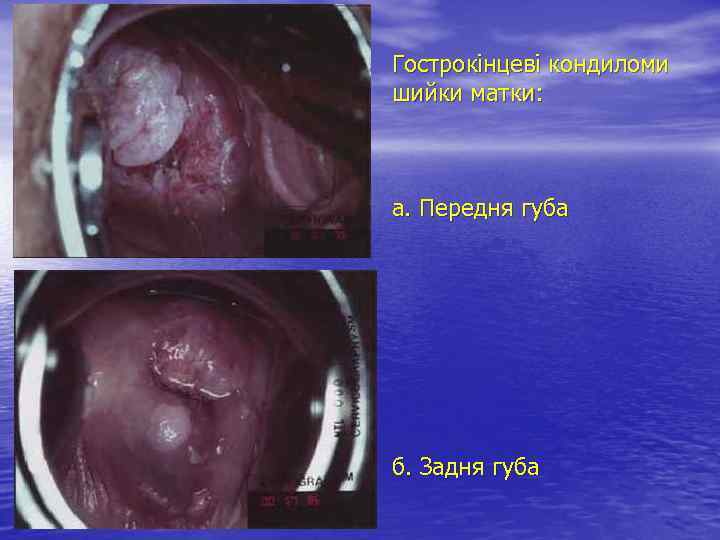 Гострокінцеві кондиломи шийки матки: а. Передня губа б. Задня губа 