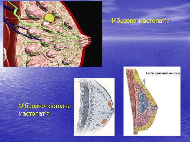Фіброзна мастопатія Фіброзно-кістозна мастопатія 